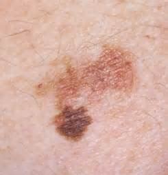show me pictures of age spots vs melanoma